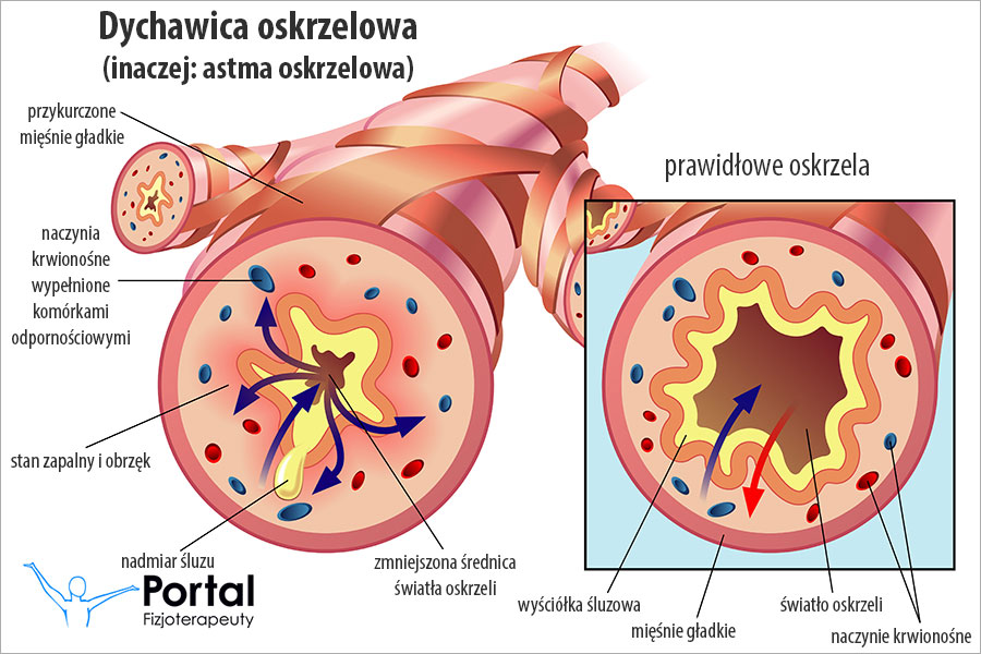 Dychawica oskrzelowa (astma oskrzelowa)