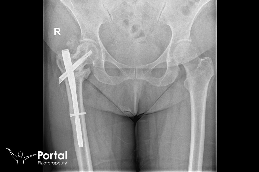 Gwóźdź śródszpikowy