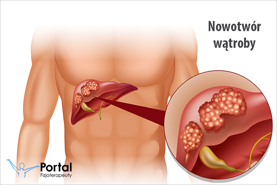 Nowotwór wątroby