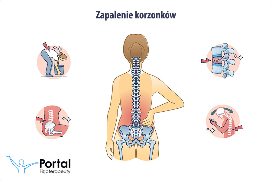 Zapalenie korzonków