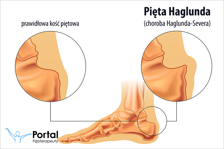 Pięta Haglunda (choroba Haglunda-Severa)