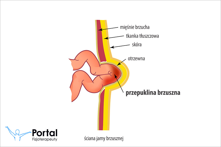 Przepuklina brzuszna