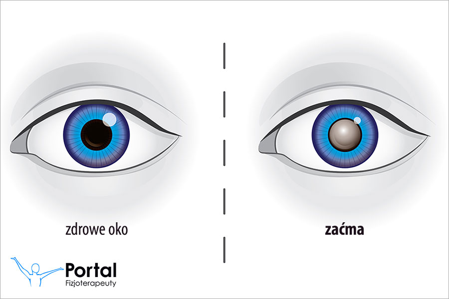 Zaburzenia widzenia (zaćma)