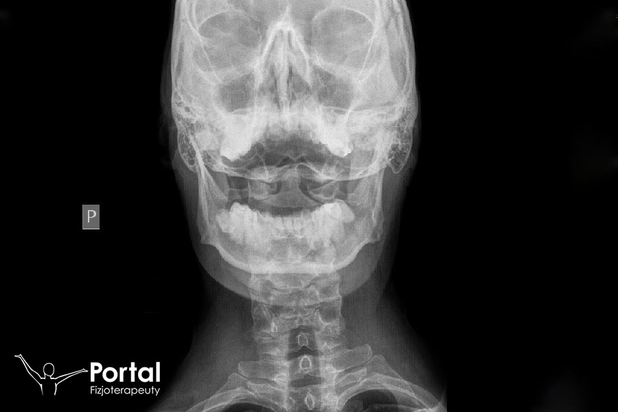 Niestabilność kręgosłupa