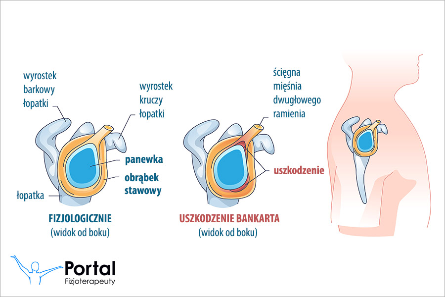 Uszkodzenie Bankarta