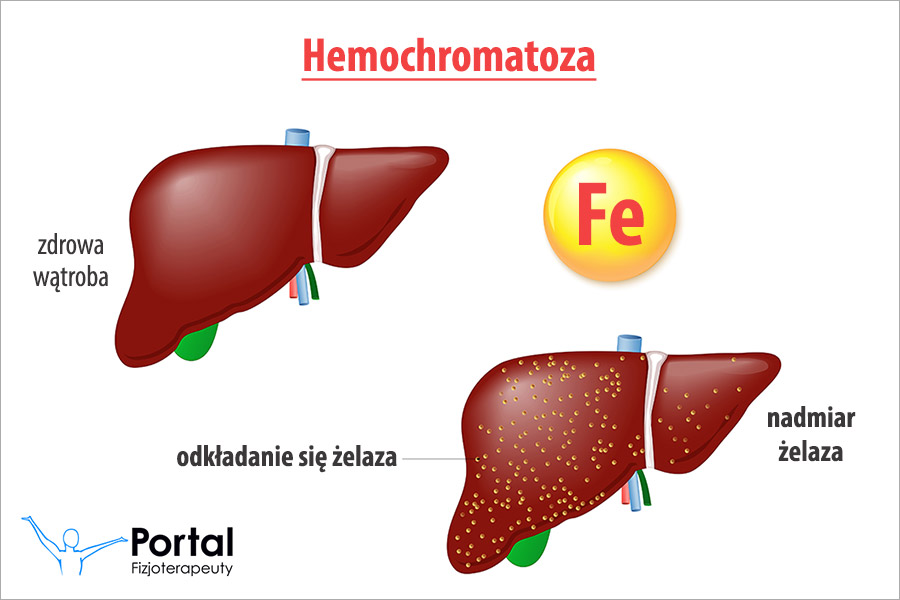 Hemochromatoza
