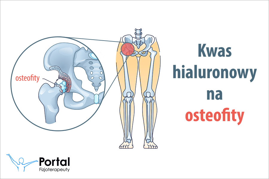 Kwas hialuronowy na osteofity