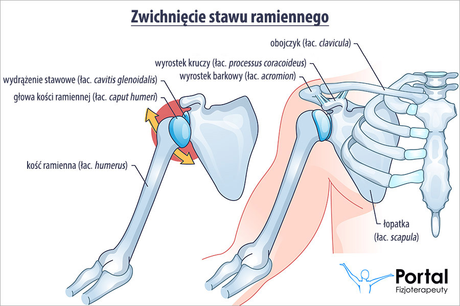 Zwichnięcie stawu ramiennego