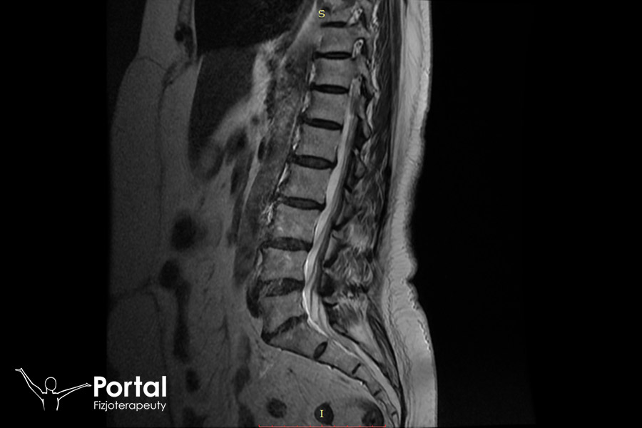 Ból kości ogonowej