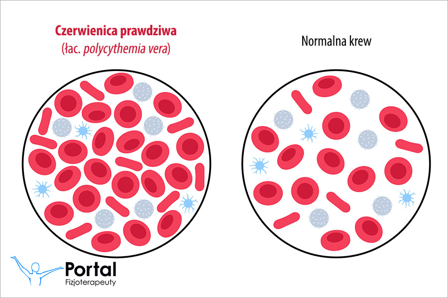 Czerwienica prawdziwa (łac. polycythemia vera)