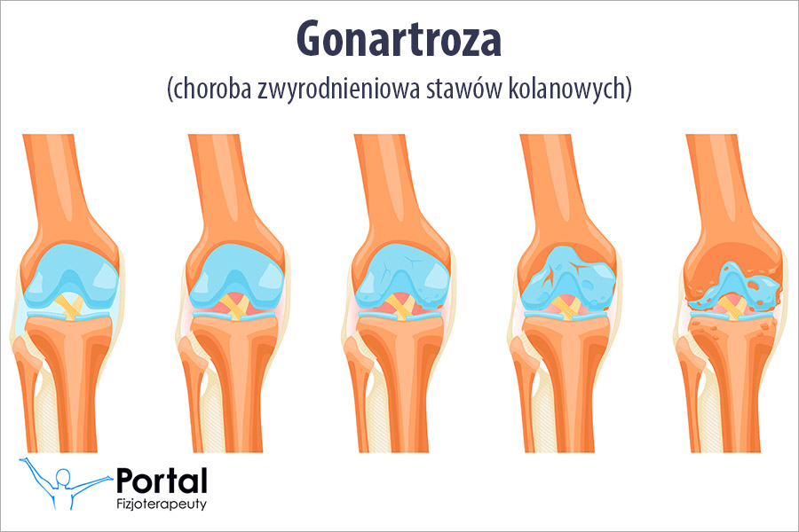 Gonartroza (choroba zwyrodnieniowa stawów kolanowych)