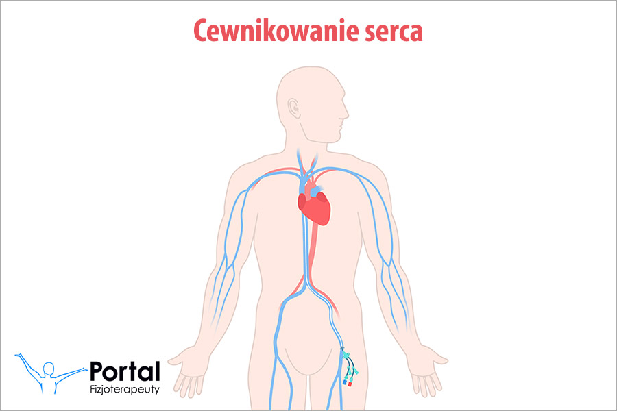 Cewnikowanie serca