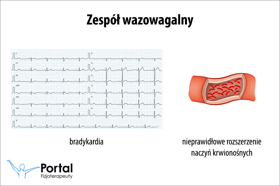Zespół wazowagalny