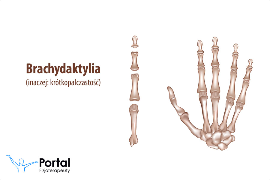 Brachydaktylia (krótkopalczastość)