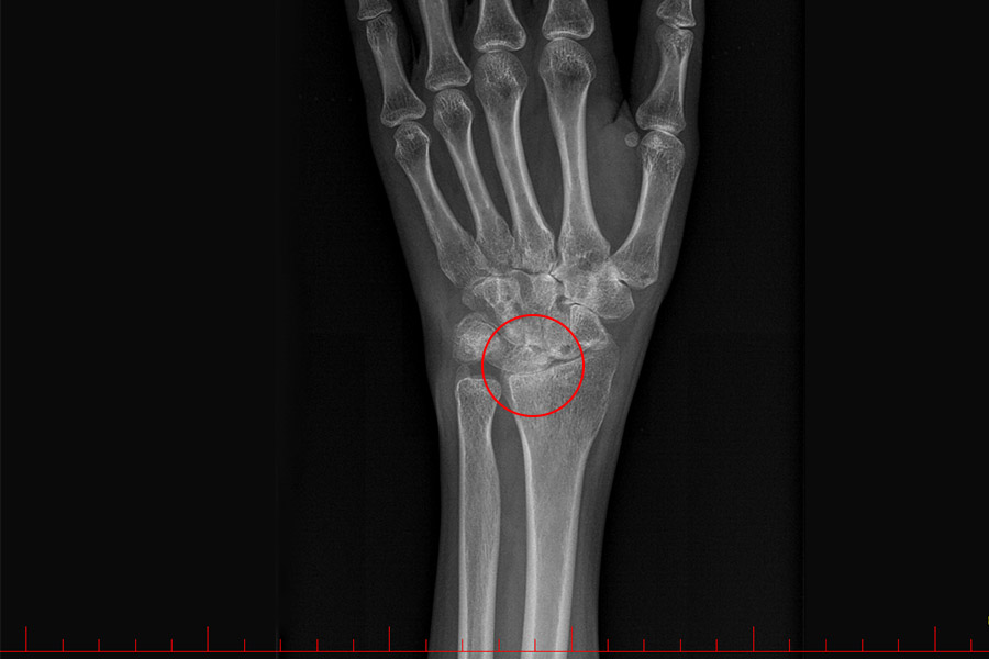 Choroba zwyrodnieniowa (nadgarstek)