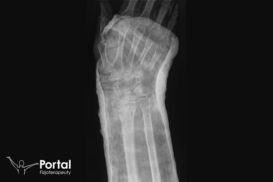 Długotrwałe unieruchomienie