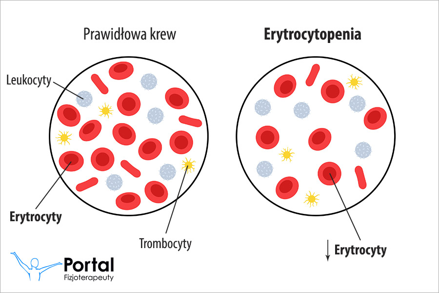 Erytrocytopenia
