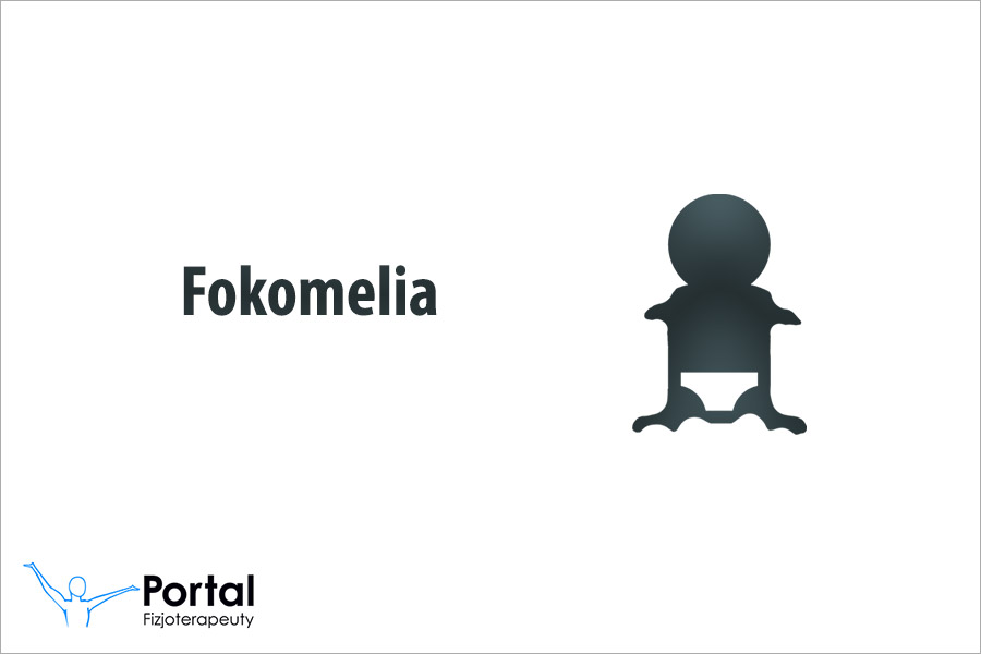 Fokomelia