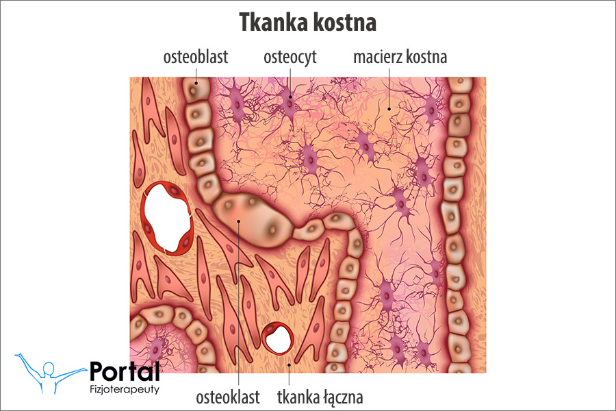 Pyknodysostoza (tkanka kostna)
