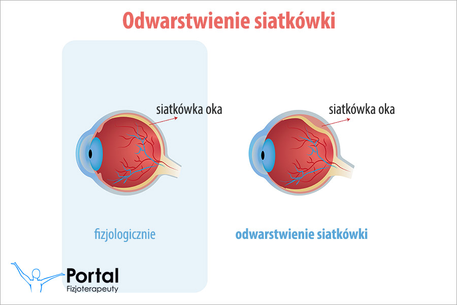 Odwarstwienie siatkówki