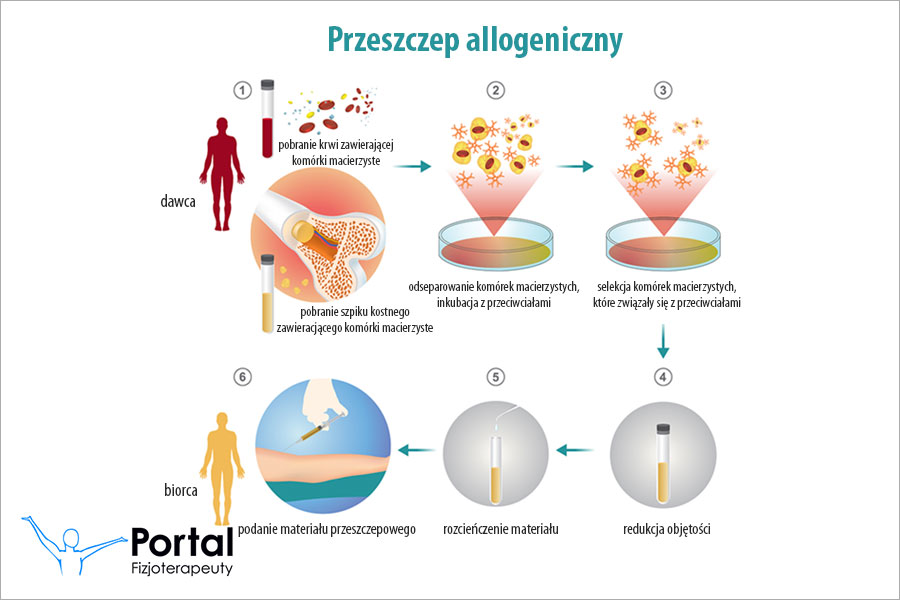 Przeszczep allogeniczny