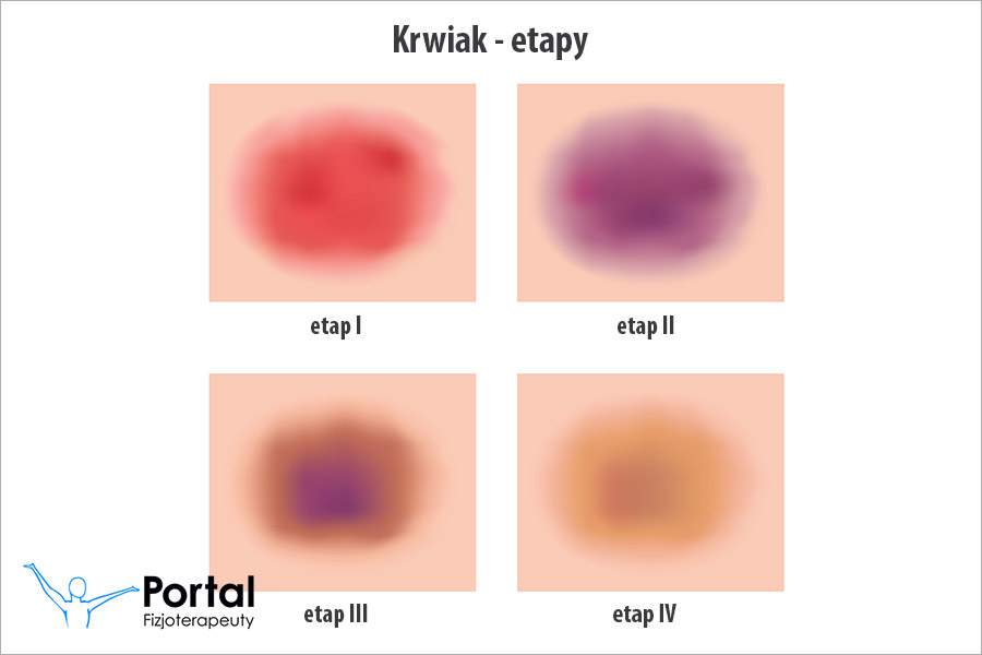 Krwiak