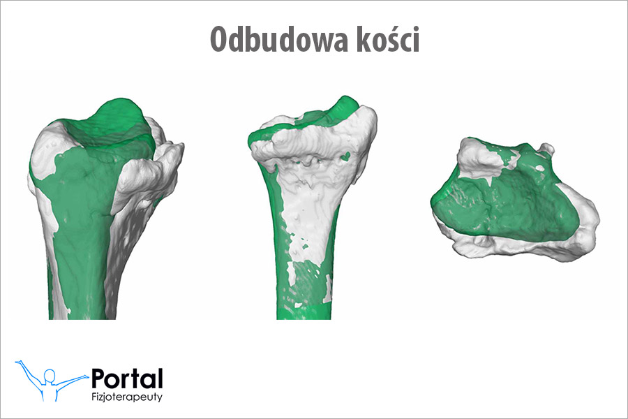 Odbudowa kości