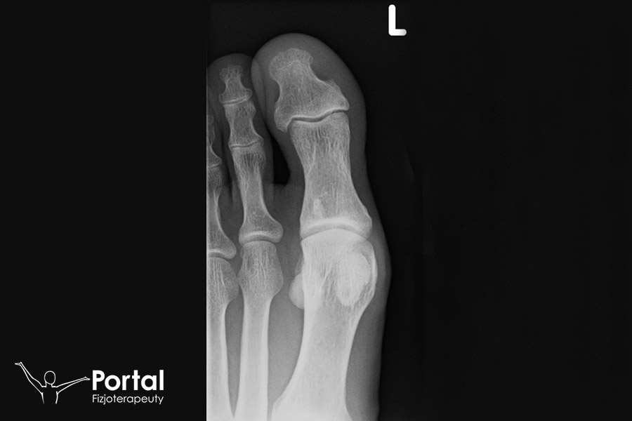 Ból podeszwy przy chodzeniu