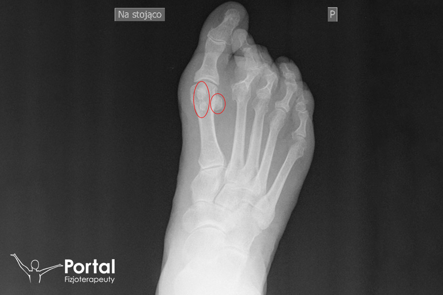 Trzeszczka (łac. ossa sesamoidea)