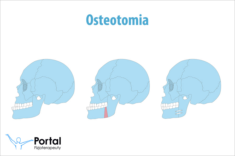 Osteotomia