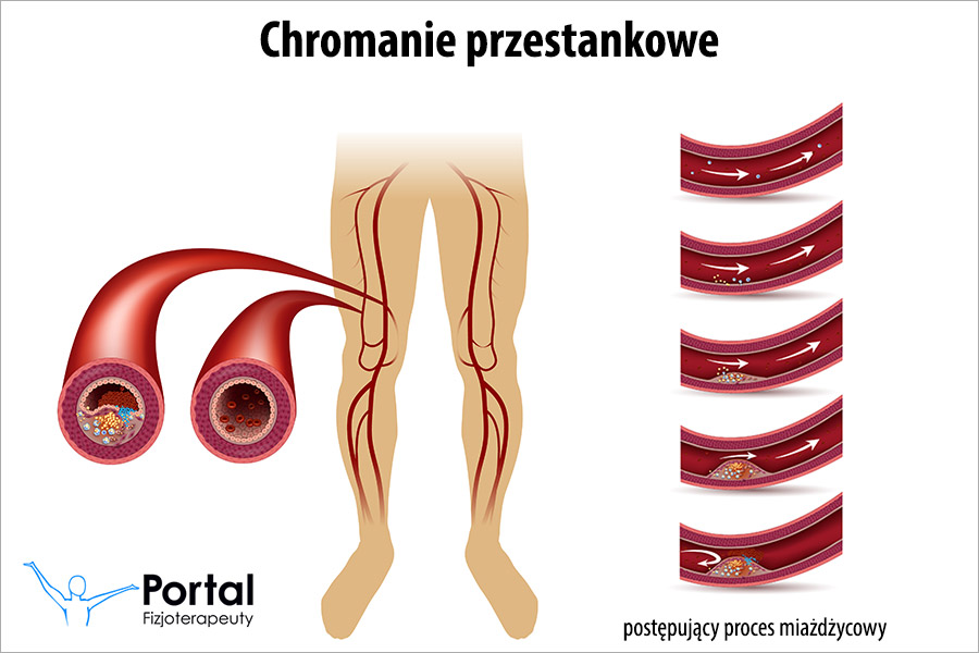 Chromanie przestankowe