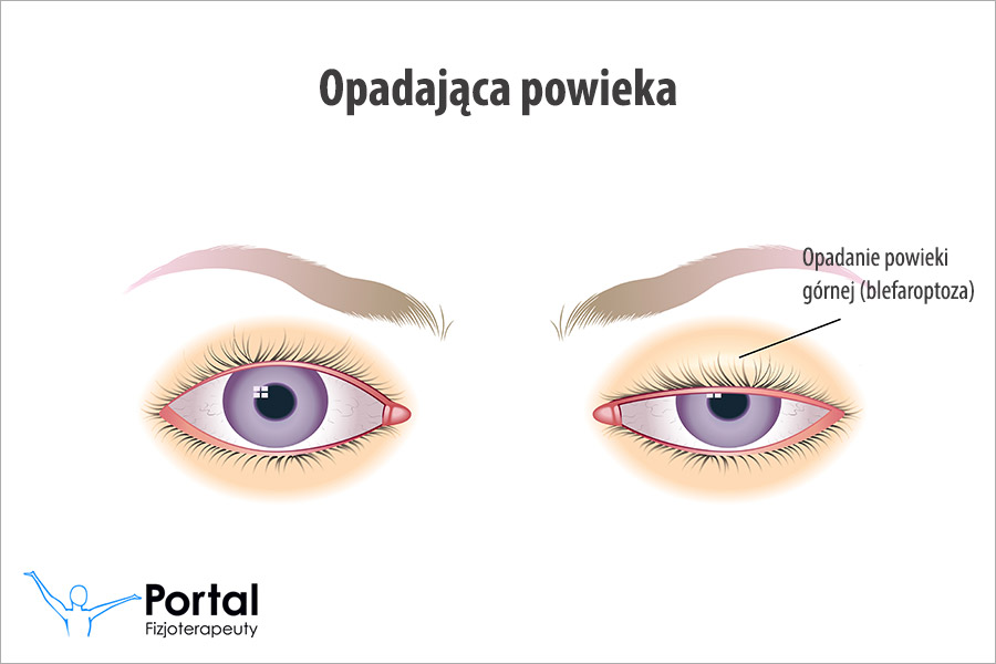 Opadająca powieka