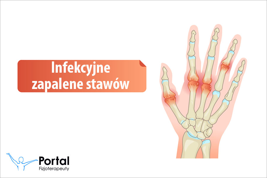 Infekcyjne zapalenie stawów