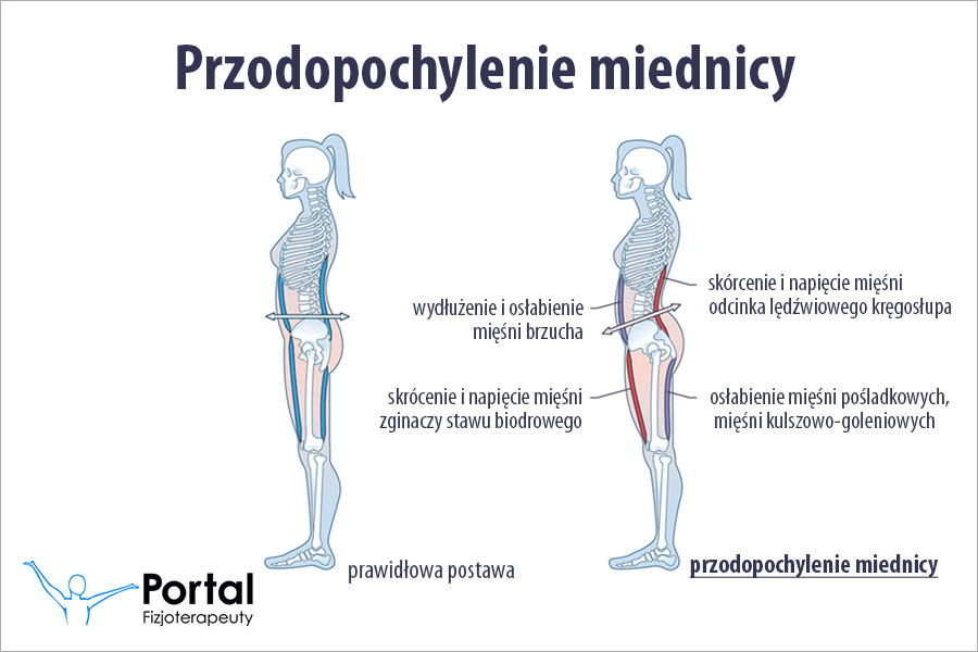 Przodopochylenie miednicy
