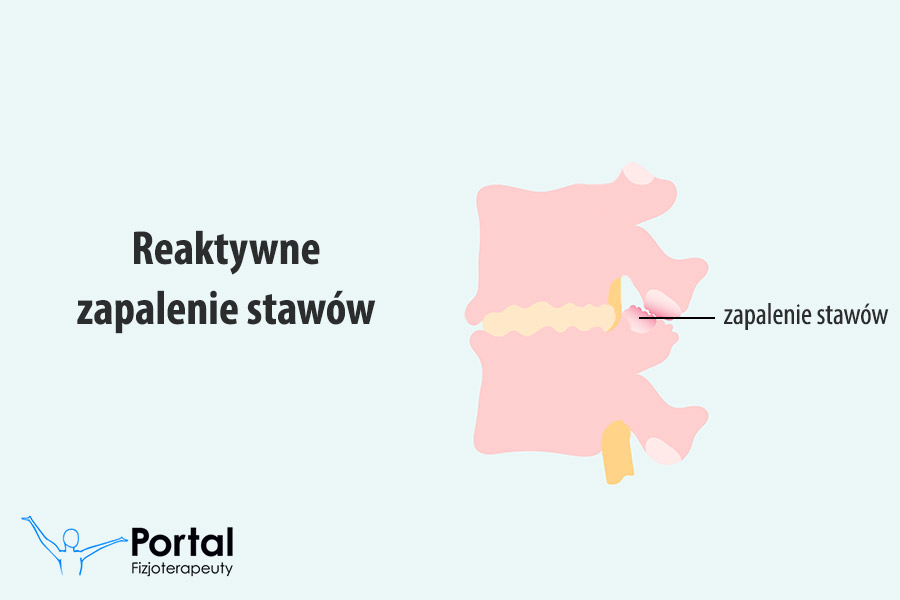 Reaktywne zapalenie stawów