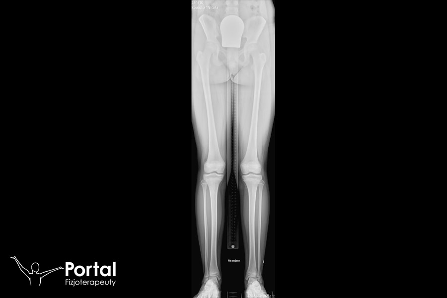 RTG pomiarowe kończyn dolnych