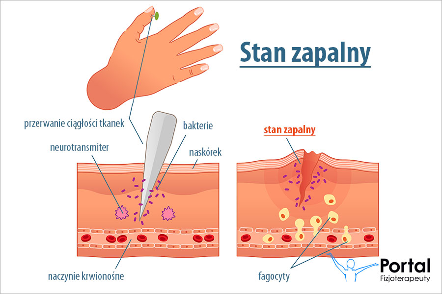 Stan zapalny