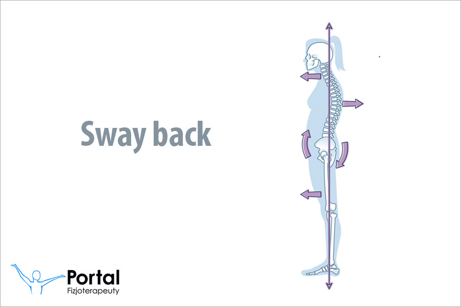 Sway back