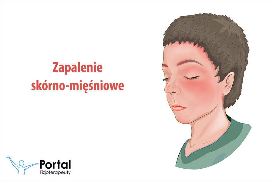 Zapalenie skórno-mięśniowe