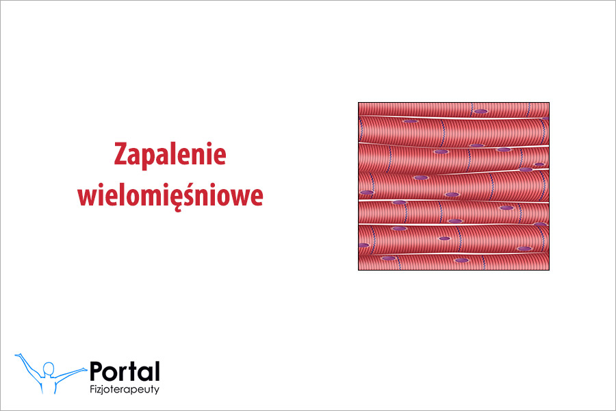 Zapalenie wielomięśniowe