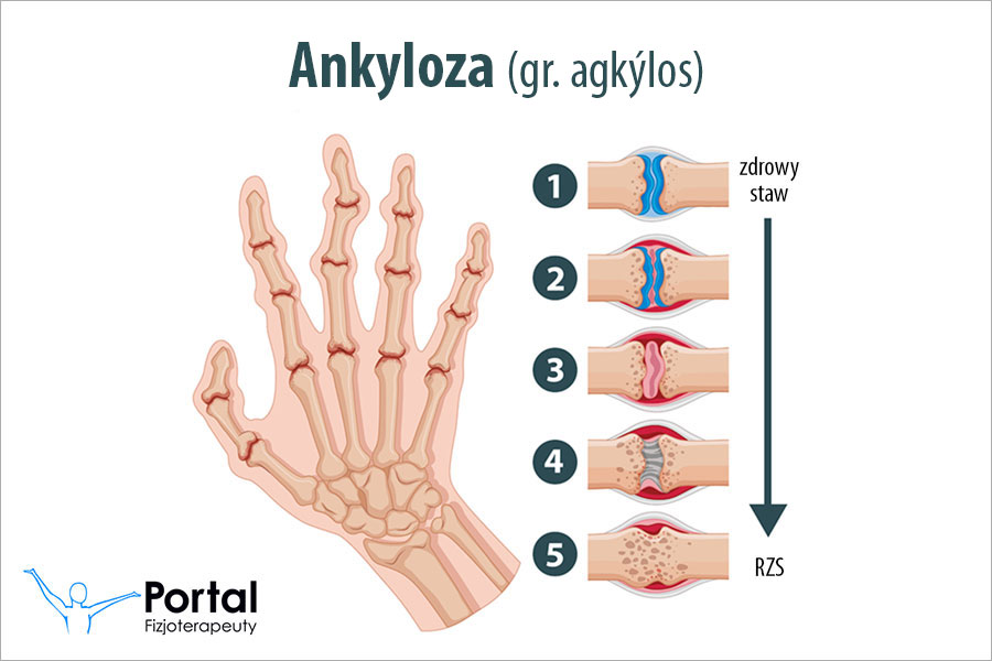 Ankyloza