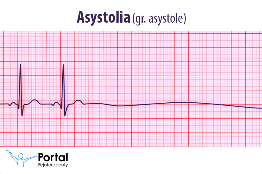Asystolia