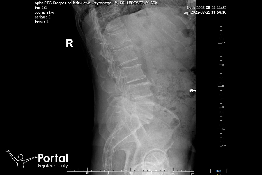 Ból odcinka lędźwiowego