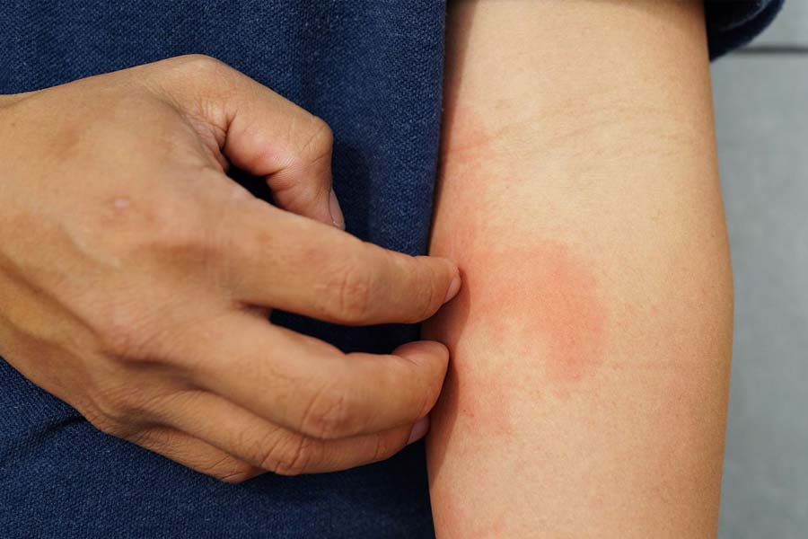 Czy ekspozycja na słońce pomaga w leczeniu egzemy?