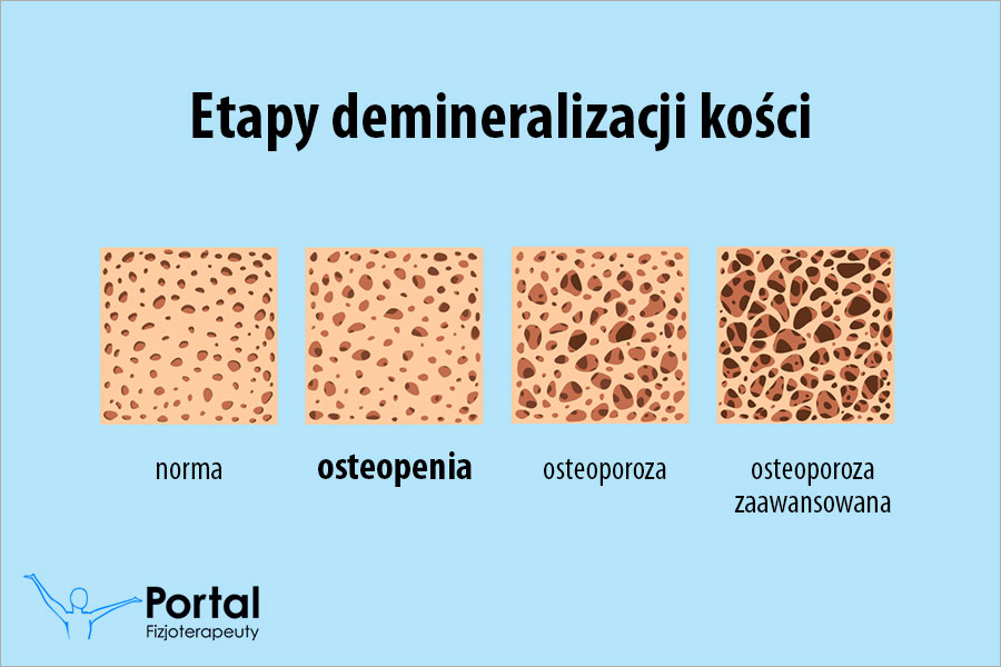 Osteopenia