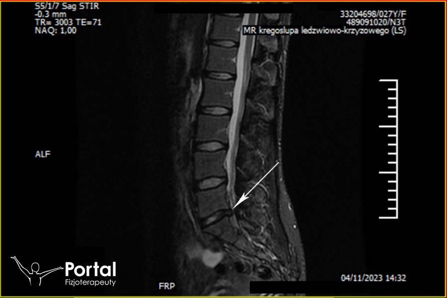 Przepuklina kręgosłupa