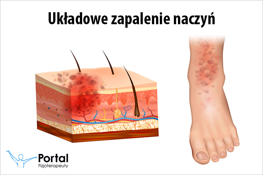 Układowe zapalenie naczyń