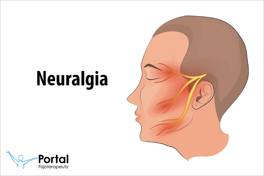 Neuralgia