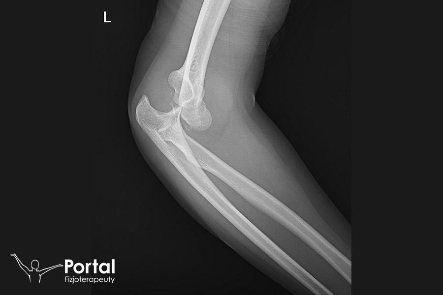 Ryc.1. Zdjęcie RTG jednego z pacjentów naszego Centrum Fizjoterapeuty po zwichnięciu stawu łokciowego.