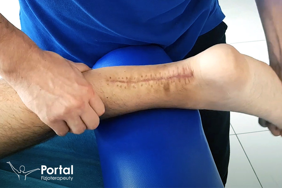 Wydłużenie ścięgna Achillesa